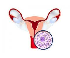 Every Women Should Know About Bacterial Vaginosis